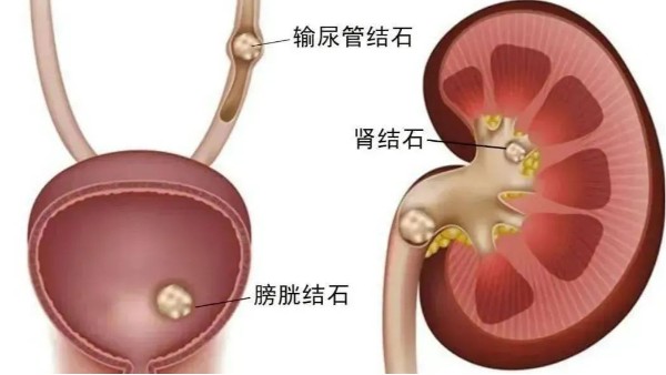 重用、活用水蛭治疗尿路结石，疗效较好