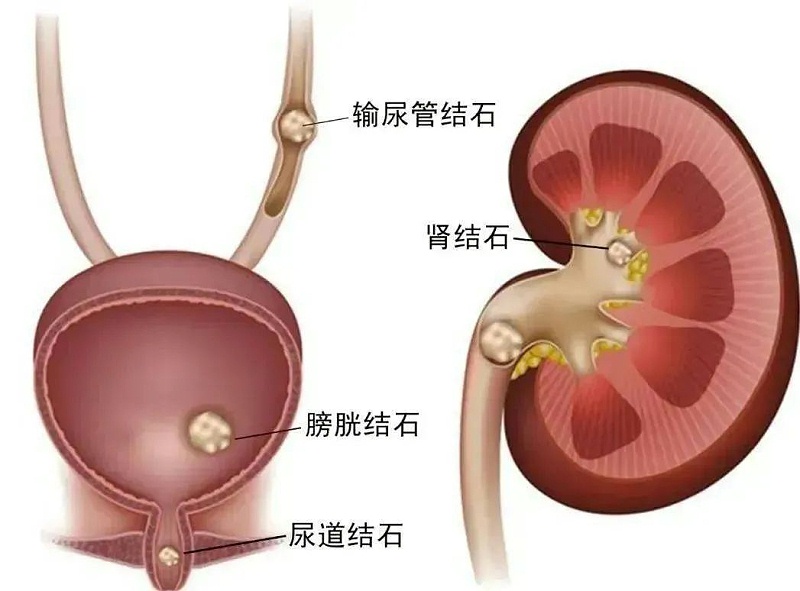 水蛭素、尿路结石、肾功能