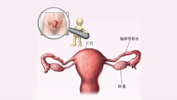 水蛭有利水道、破积聚之功，可用于治疗输卵管积水