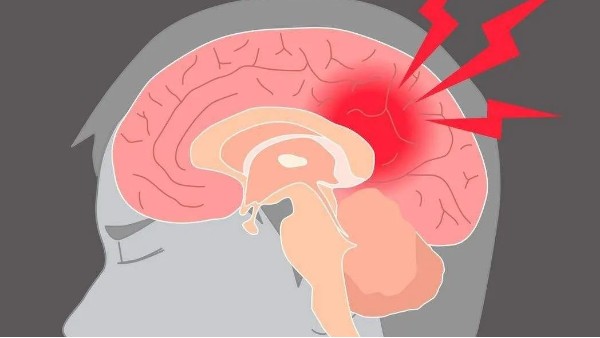 水蛭治疗缺血性脑血管病疗效肯定、安全简便，已被各家公认