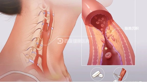 真实案例 | 从有到无，一个月多双颈动脉斑块“消失术”
