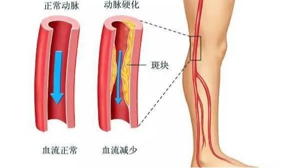 水蛭在改善下肢动脉硬化性闭塞症中发挥重要疗效，安全性及可行性较高