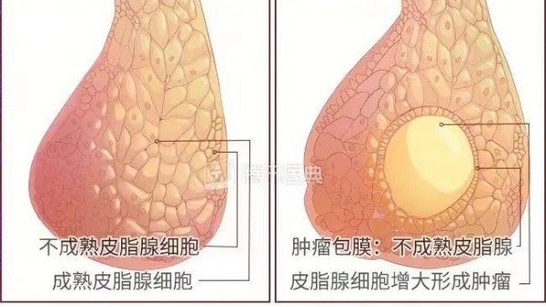 真实案例 | 肿瘤克星，百姓福音——现代壮医水蛭疗法