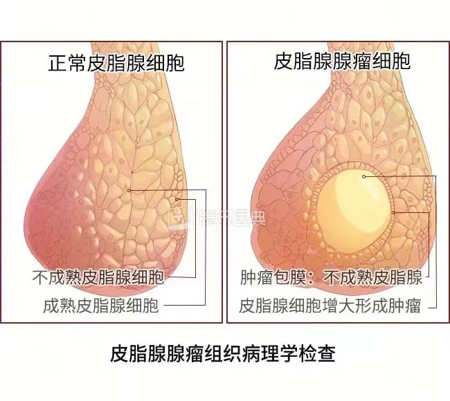 壮医水蛭疗法，天然水蛭素胶囊