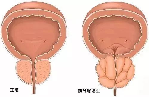 水蛭素、前列腺增生、前列腺肥大