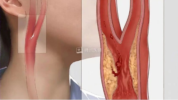 真实案例 | 血管里有斑块怎么办？告诉你一个方法