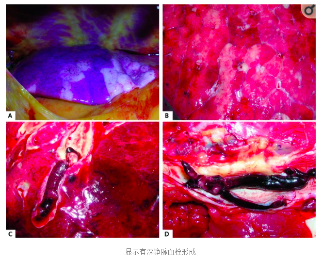 水蛭素、阳康、乌梅、壮医水蛭疗法