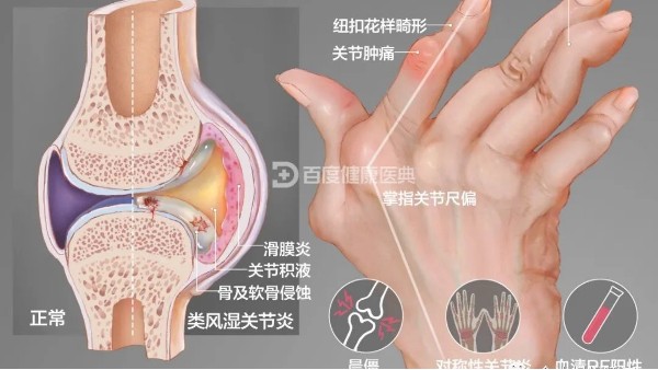 真实案例：类风湿关节炎久治不愈，有效根治才是关键！