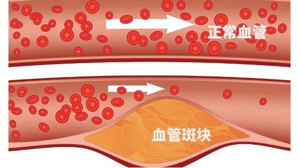 微血栓堵塞可能会致命