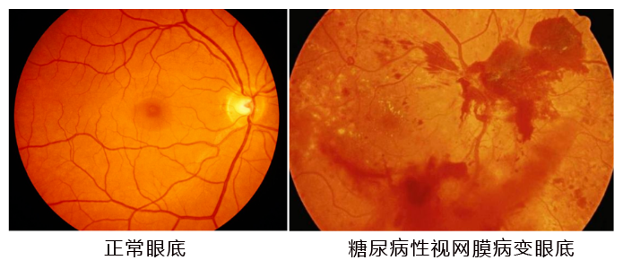 水蛭素、糖尿病、视网膜病变