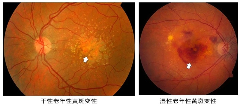 壮医水蛭疗法,天然水蛭素