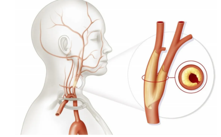 水蛭素、颈动脉斑块、粥样硬化
