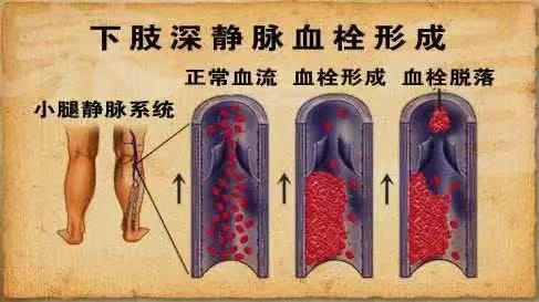 水蛭素、水蛭疗法、下肢静脉栓塞