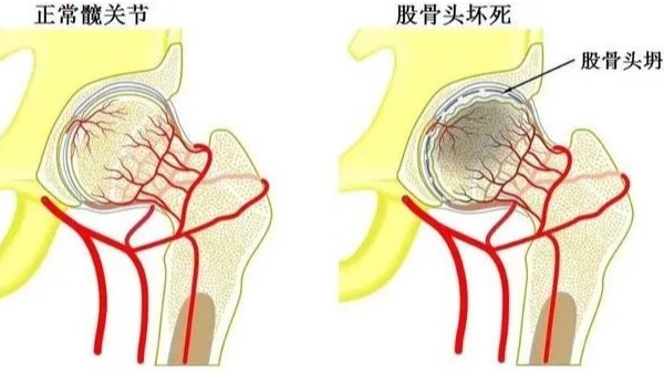 水蛭通脉汤治疗股骨头无菌性坏死效果显著