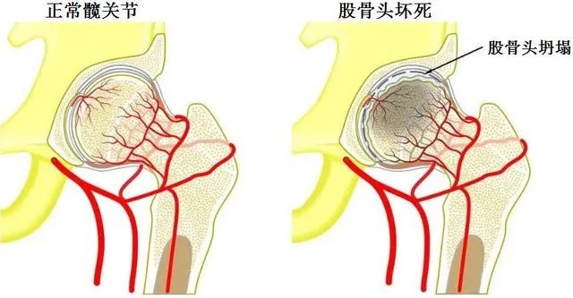 水蛭素-股骨头坏死-水蛭通脉汤